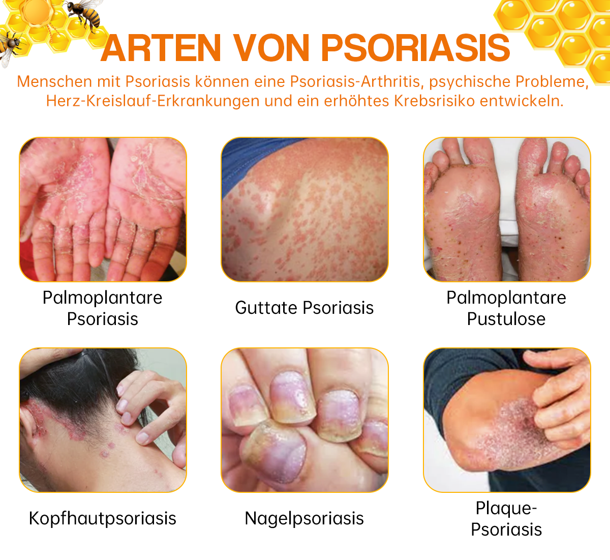 1+1 GRATIS | Psoriasisbehandelingsspray, bevrijd uw huid vandaag nog!