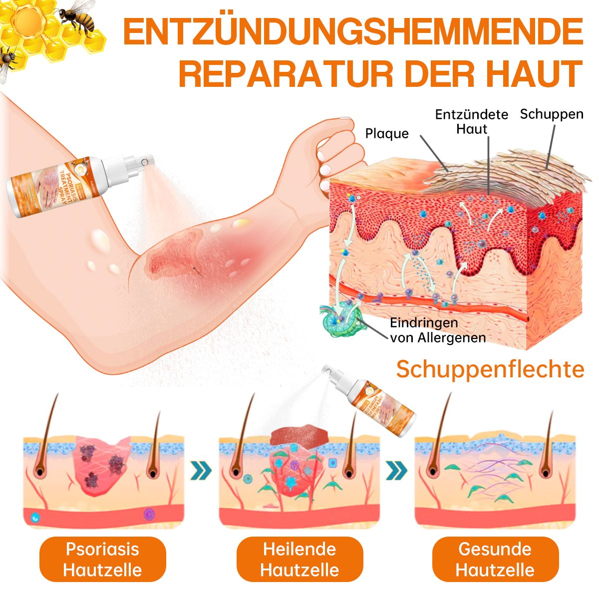 1+1 GRATIS | Psoriasisbehandelingsspray, bevrijd uw huid vandaag nog!