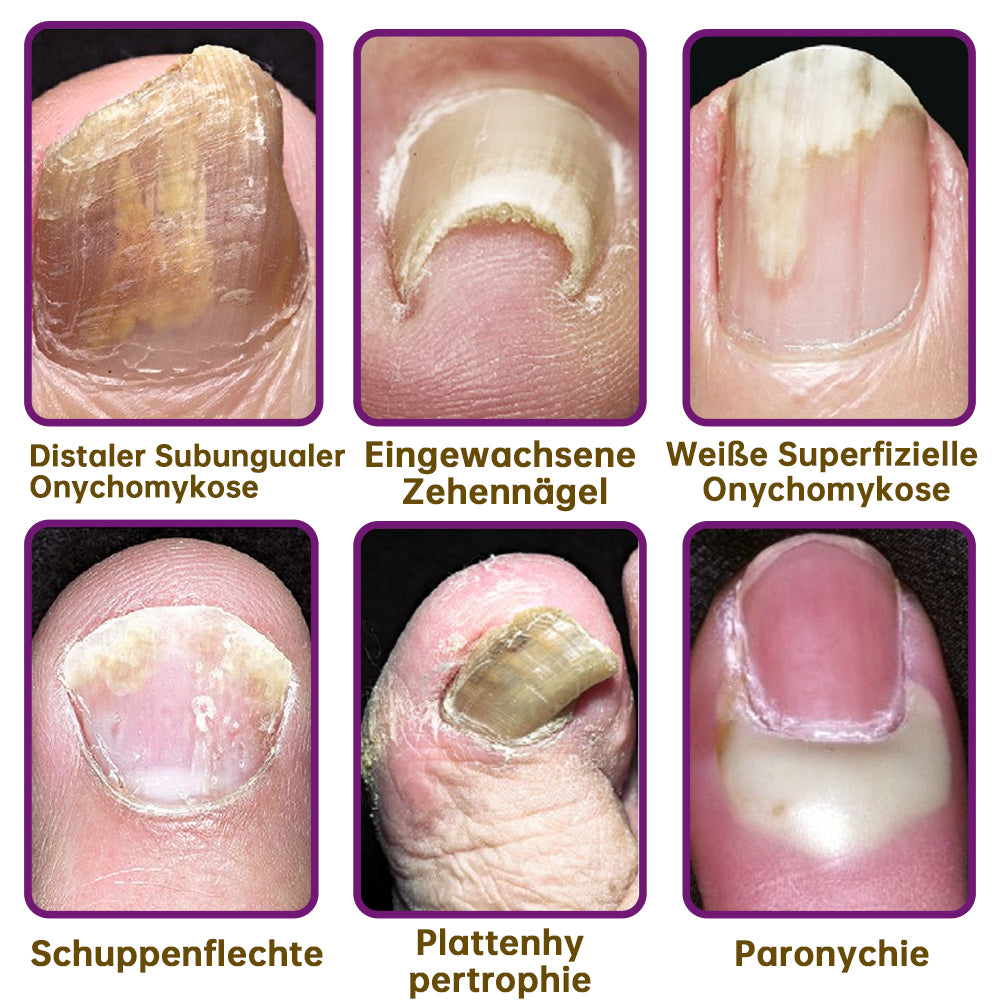 1+1 GRATIS | FungiFree™ Schimmelvrij bijengif nagelbehandelingsserum