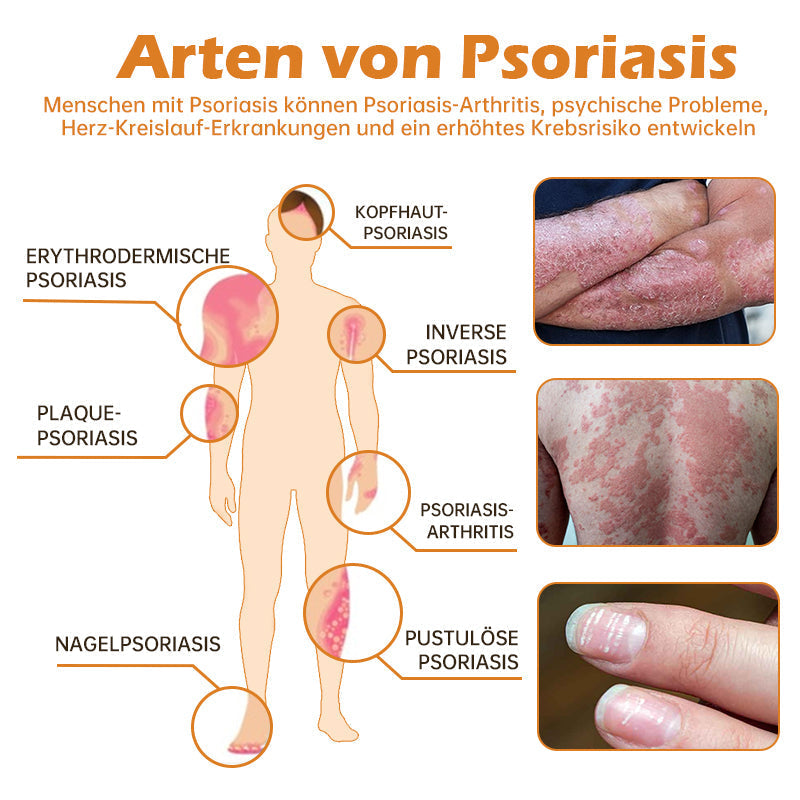 1+1 GRATIS | PsoriaHeal™ - Bijengif psoriasis behandelingsspray (geschikt voor alle huidtypes)