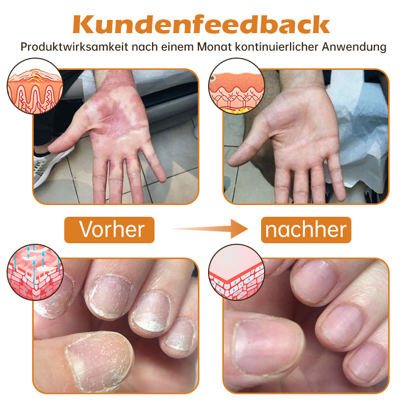 1+1 GRATIS | PsoriaHeal™ - Bijengif psoriasis behandelingsspray (geschikt voor alle huidtypes)